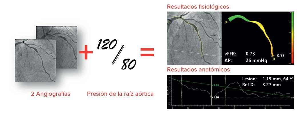 2 angiografias mas la presión de la raiz aórtica